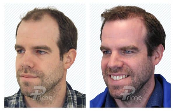 Male-Hairlines-9C---2208-grafts-6-mo-post-op